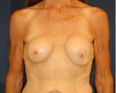 Feel Beautiful - Breast Implant Removal 202 - Before Photo